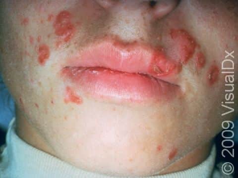 Impetigo is a superficial skin infection caused by staph or strep bacteria. The crusting on the surface of the skin seen on the upper left lip is typical of impetigo.