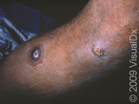 This image displays thick scaling, crusts, and erosions of the skin surface typical of impetigo.