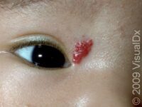 Strawberry Hemangioma (Infantile Hemangioma) – Infant
