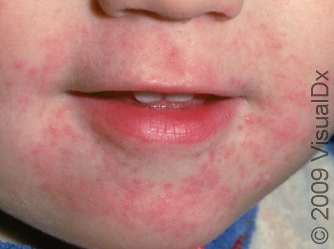 This image displays inflammation and rash typical of irritant contact dermatitis due to frequent wetting and drying of the skin.