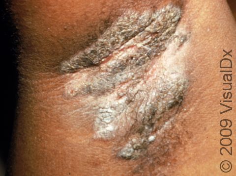 This image displays a child with irritant dermatitis from use of a deodorant.