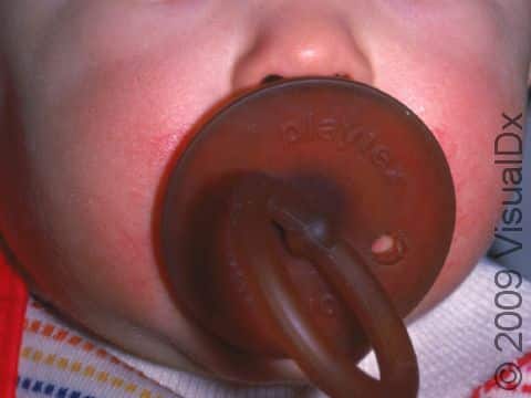 Constant drooling around this pacifier caused irritant contact dermatitis (skin inflammation).