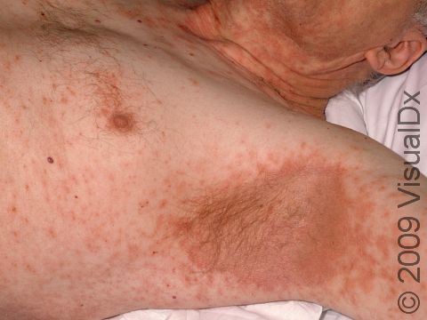 This image displays scaling bumps and slightly elevated lesions typical of dermatitis, with severe involvement in the patient's armpit.