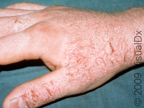 This image displays scaly, red, cracked skin typical of irritant dermatitis.