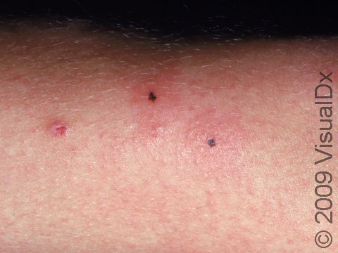 Contact dermatitis is typically displayed as areas of redness that are not well-defined with small scabs from scratching.