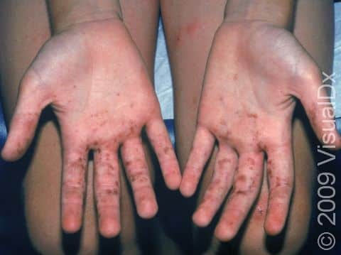 This image displays a child that has an allergic reaction to a plant (see red areas on the thigh) with staining from the plant berries still on the hands.