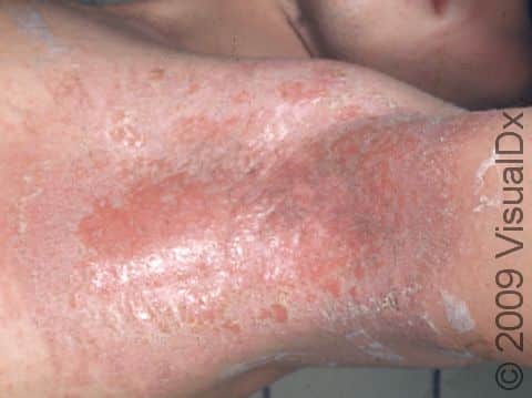 This image displays severe irritant dermatitis.