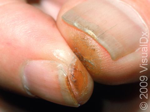 This image displays irritant dermatitis from tobacco and handling cigarettes.