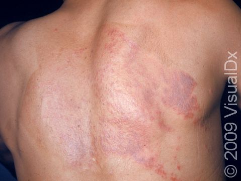 This image displays irritant dermatitis on a young man from ?mustard? plaster.