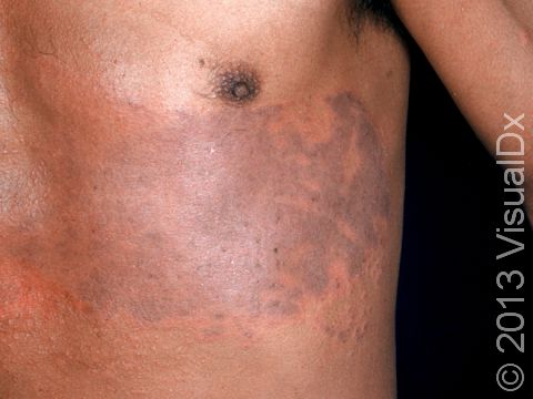 This image displays a patient with irritant dermatitis caused by application of mustard plaster.