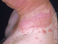 Irritant Contact Dermatitis