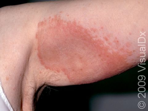 This image displays fine scaling of this large grouping of slightly elevated lesions typical of dermatitis.