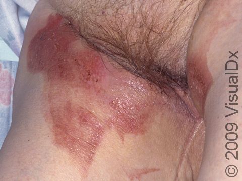 This image displays irritant dermatitis caused by a direct chemical reaction or friction on the skin.