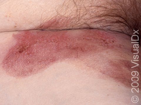 This image displays irritant dermatitis, an irritation caused by a direct chemical reaction or friction on the skin.