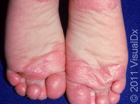 This image displays redness and scaling at the bottom of the feet typical of juvenile plantar dermatosis.