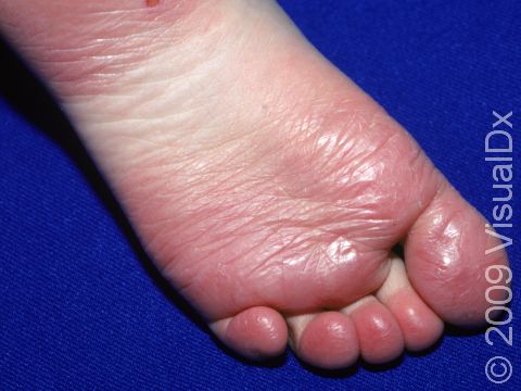 This image displays the shiny appearance of the sole of a foot due to juvenile plantar dermatosis.