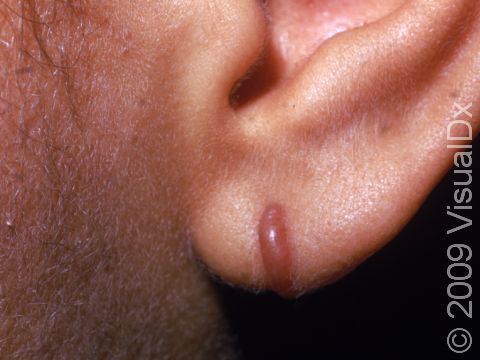 This image displays a keloid at the site of ear piercing.
