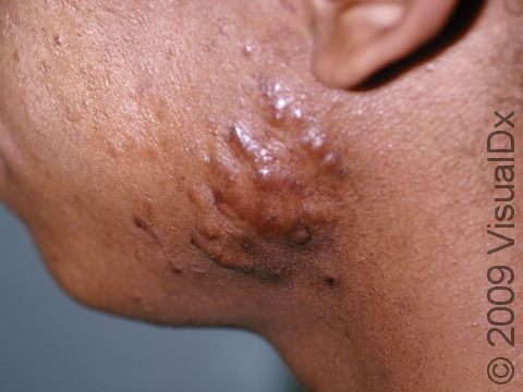 This image displays keloids from acne scars.