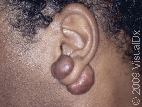 When the ear is pierced, lumpy keloids may occur on both sides of the earlobe.