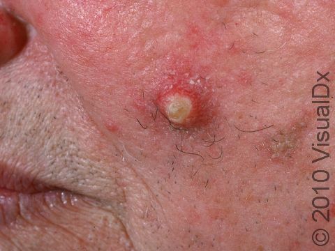 Typical to keratoacanthomas, this lesion is red and inflamed at the base.