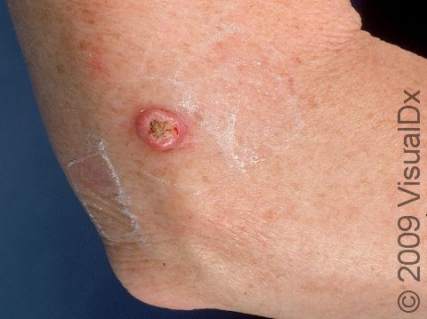 This image displays a keratoacanthoma on an elbow.