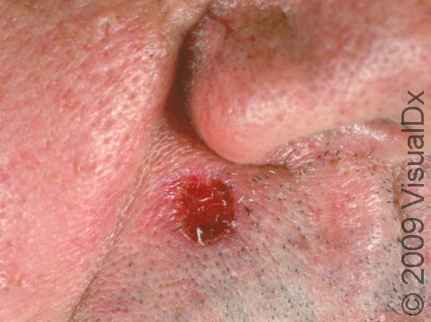 This image displays a keratoacanthoma, a form of skin cancer, that needs a biopsy by a dermatologist and full removal.