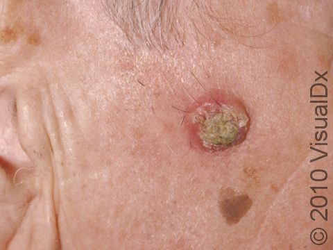 Keratoacanthomas are thought to be a type of squamous cell skin cancer. They typically have a crater-like appearance with a slightly elevated lesion and a thick crust.