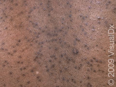 This image displays multiple bumps, typical of keratosis pilaris, with darker pigmentation at each elevation of the skin specific to people with darker skin.