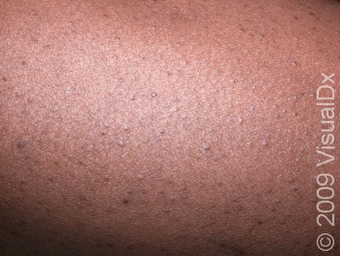 This image displays small bumps around the hair follicle typical of keratosis pilaris.