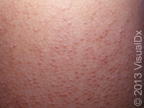 bunke Forestående Allerede Keratosis Pilaris Condition, Treatments and Pictures for Children -  Skinsight