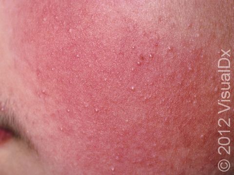This image displays small bumps on the hair follicles typical of keratosis pilaris.