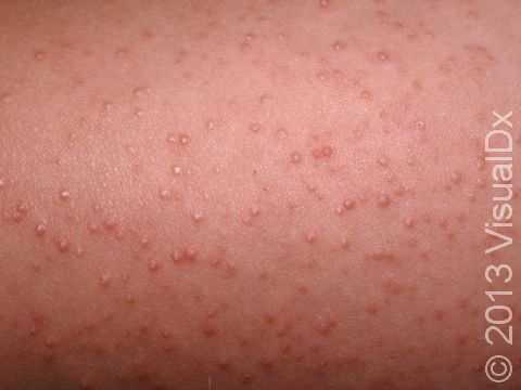 Keratosis Pilaris Condition, Treatments and Pictures for Children -  Skinsight