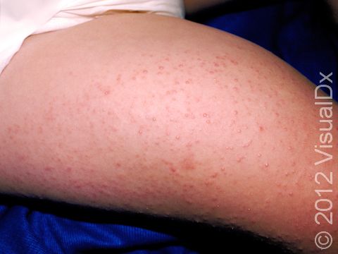 This image displays small, scaly bumps on each hair follicle typical of keratosis pilaris.