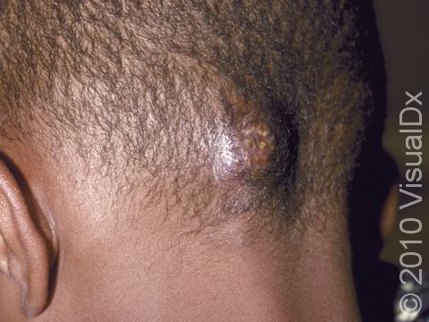 How to avoid getting ringworm from your barber | Daily Mail Online