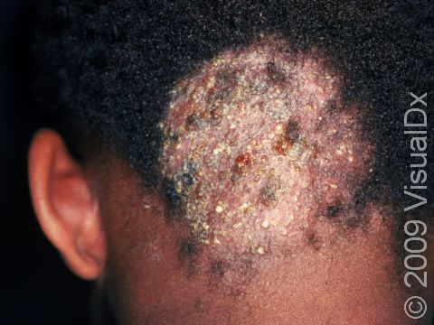 This image displays numerous pus-filled lesions, scabs, and swelling, from a kerion (caused by scalp ringworm).