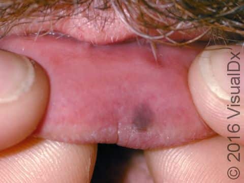 A lentigo on the lip is a flat, light brown spot, usually found on the lower lip.