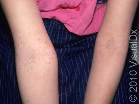 Lentigos are freckles, appearing as flat, light brown spots on the skin.