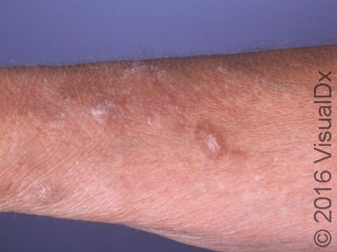 This image displays thick areas of skin on the forearms typical of lichen simplex chronicus.