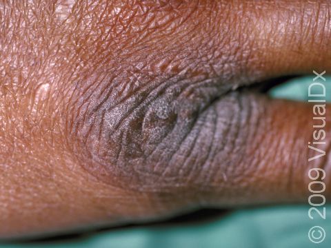 Thick, scaly, slightly elevated lesions with pronounced skin lines occur when the skin is repeatedly rubbed.