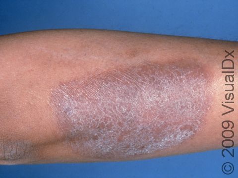 This image displays scaly skin due to lichen simplex chronicus.
