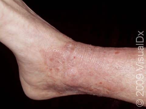 Chronic rubbing or scratching of the same area leads to lichen simplex chronicus, with thickened, rough, and sometimes red, broken skin areas.