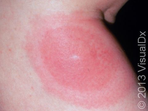 Lyme disease can display multiple rings, resembling a bull's-eye, of redness, suggesting an enlarging rash spreading from the bite site of the tick.