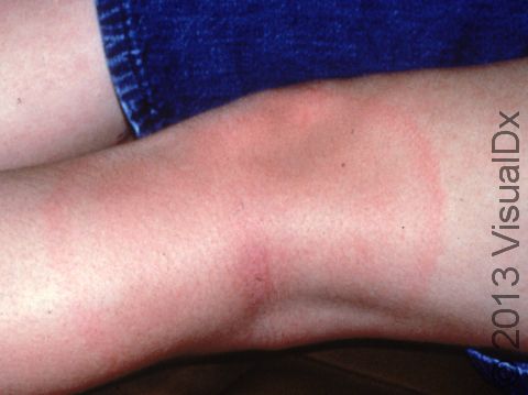 Pink or red circles of skin surrounding the bite site of the tick bite are typical of Lyme disease.