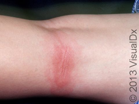 Lyme disease may simply be displayed as a subtle area of pink or red skin rather than the classic bull's-eye rash.