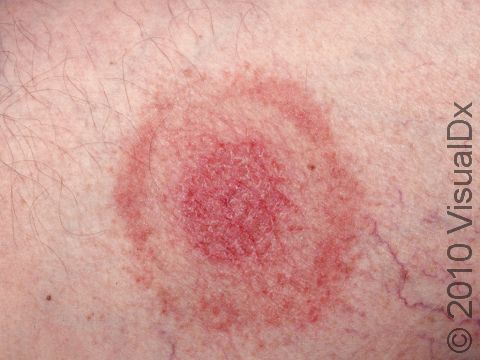 The rash of Lyme disease typically consists of a red or pink circle, or sometimes a ring within a ring appearing like a bull's-eye.