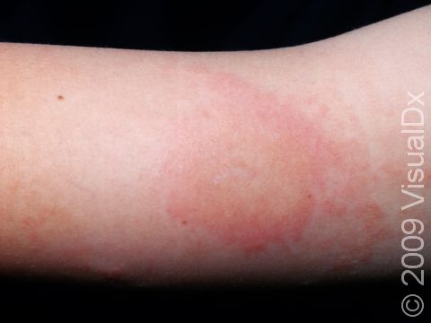 In Lyme disease, the only sign of infection may be a very faint, quickly disappearing area of pink skin.