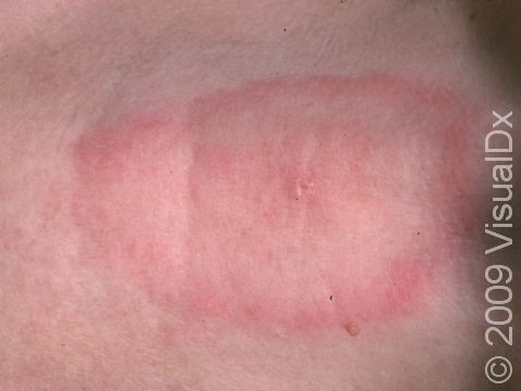 A pink, ring-like, slightly raised rash that expands outward is a classic sign of Lyme disease.