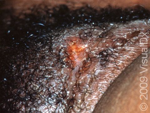 A painless, open sore (ulcer) forms in the first stage of lymphogranuloma venereum.