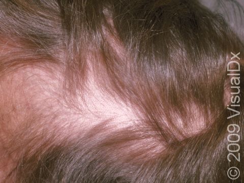 This man has worsening male-pattern hair loss resulting from the medication Tenormin.