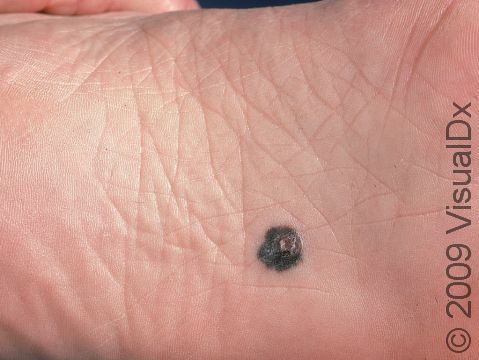 This melanoma started as a flat, irregular dark spot but has developed a raised, crusted area.